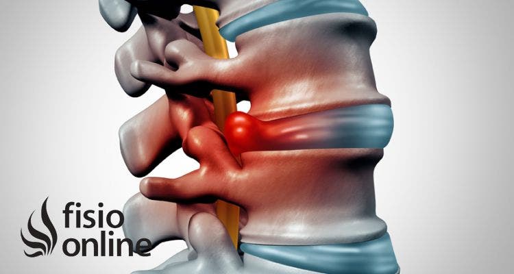 Hernias inyeccion discales para